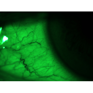 Eye Vessel Examination Under Magnification 